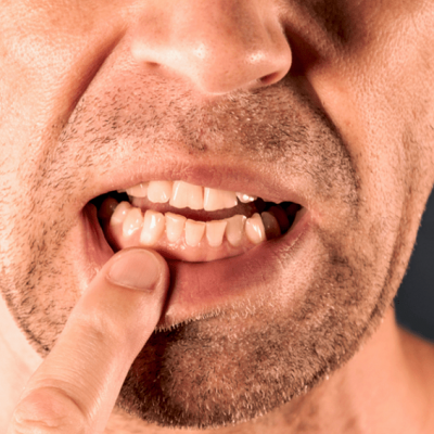 Obesity and Gum Disease