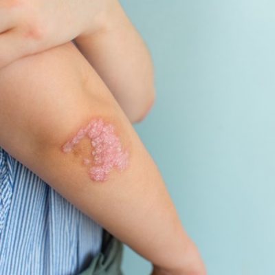 Psoriasis on an arm.