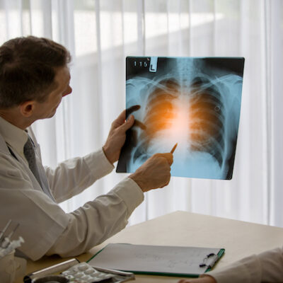 Doctors examining a lung x-ray.