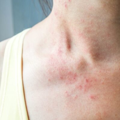 Young woman with skin rash on her neck.
