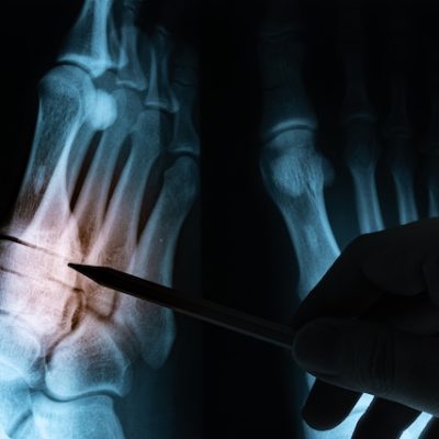 X-ray film with doctor's hand.