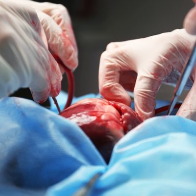 Surgeon doing heart operation.