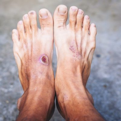 Diabetes wound on a patient's foot.