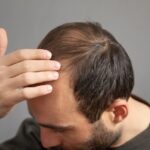Man with hair loss.