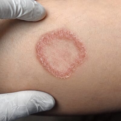 Circular fungal skin infection on an arm.